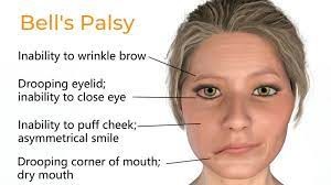 https://cdn5.dcbstatic.com/files/m/e/medpro_docebosaas_com/userfiles/20702/bells_palsy.jpg