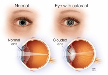 https://cdn5.dcbstatic.com/files/m/e/medpro_docebosaas_com/userfiles/20702/cataract.jpg