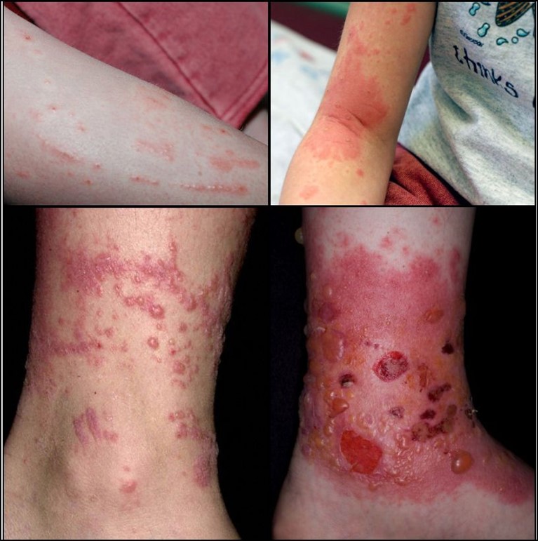 https://cdn5.dcbstatic.com/files/m/e/medpro_docebosaas_com/userfiles/20702/dermatitis.jpg
