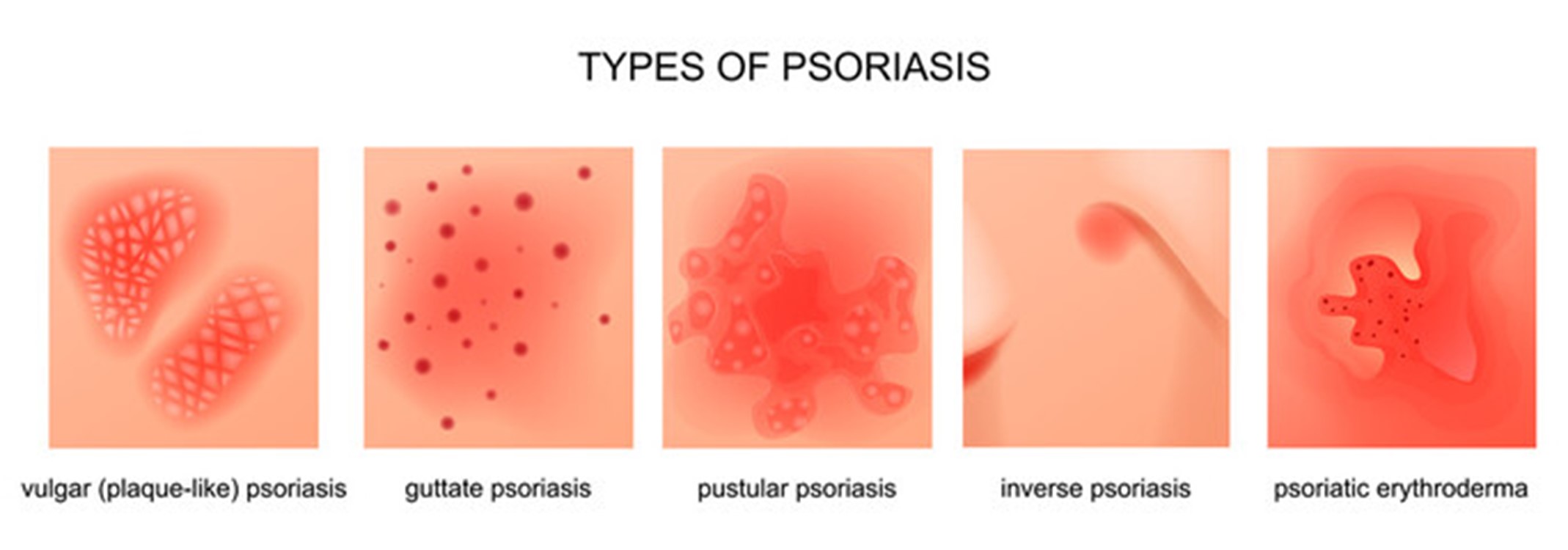 https://cdn5.dcbstatic.com/files/m/e/medpro_docebosaas_com/userfiles/20702/psoriasis.jpg