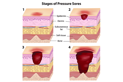 https://cdn5.dcbstatic.com/files/m/e/medpro_docebosaas_com/userfiles/20702/ulcers.png
